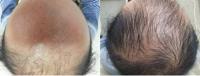 Hairgen Hair Loss Control Centre image 1